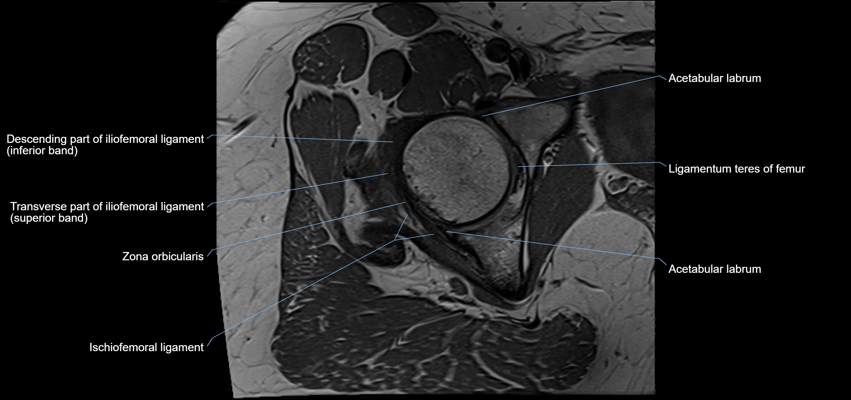 Hip ligament anatomy axial 3T MRI image -img-13001-00016.webp